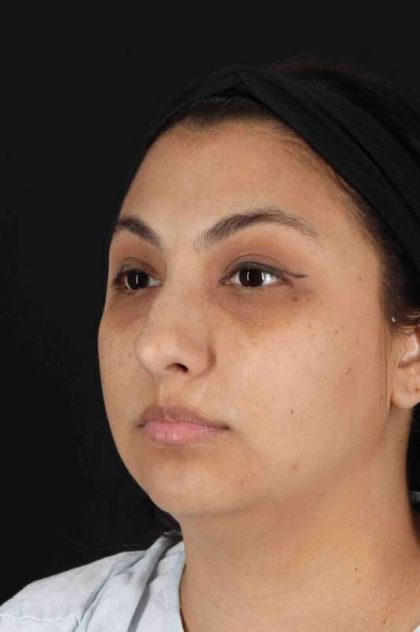 Rhinoplasty Before & After Patient #2994