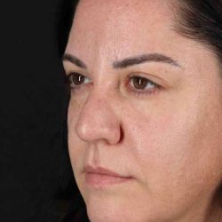 Browlift Before & After Patient #1363