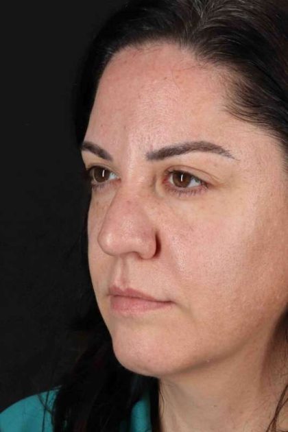 Browlift Before & After Patient #1363
