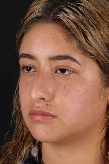 Rhinoplasty Before & After Patient #3016