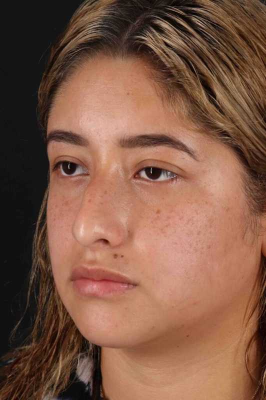 Rhinoplasty Before & After Patient #3016