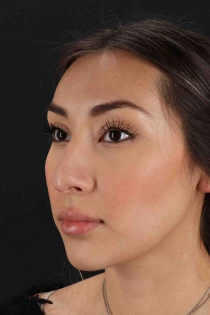 Rhinoplasty Before & After Patient #3027