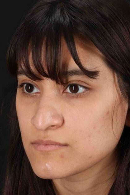 Rhinoplasty Before & After Patient #3038