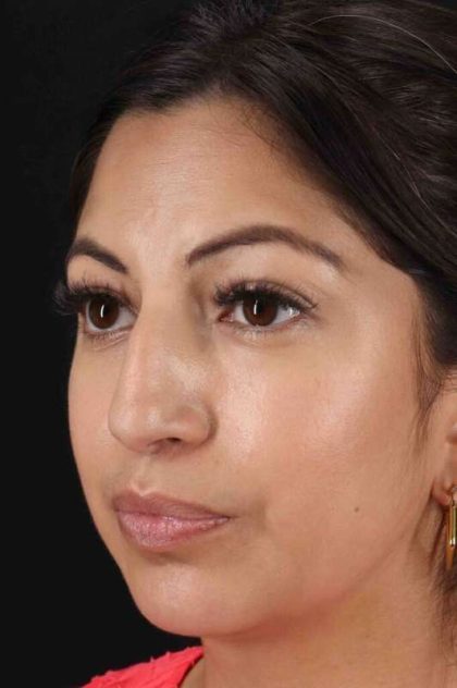 Rhinoplasty Before & After Patient #3049