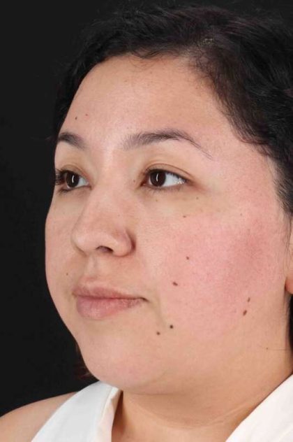 Rhinoplasty Before & After Patient #3060