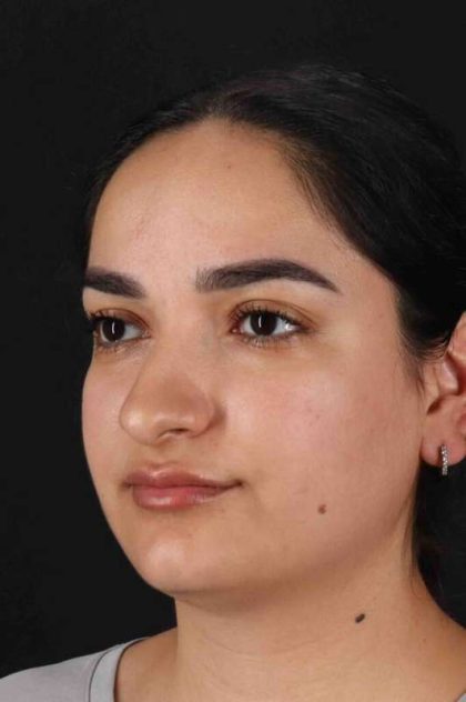 Rhinoplasty Before & After Patient #3071