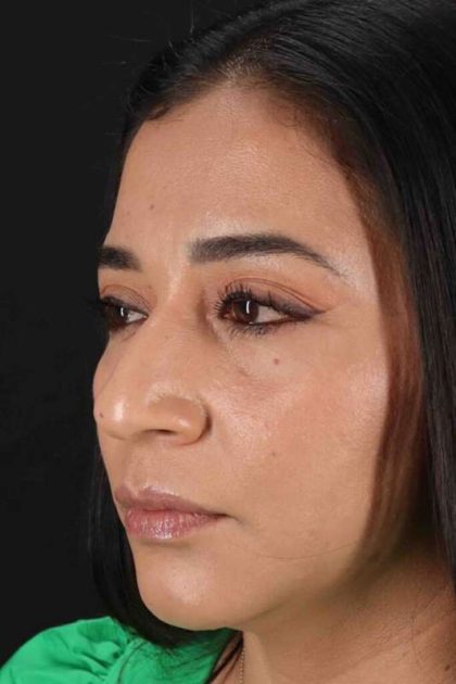 Rhinoplasty Before & After Patient #3082
