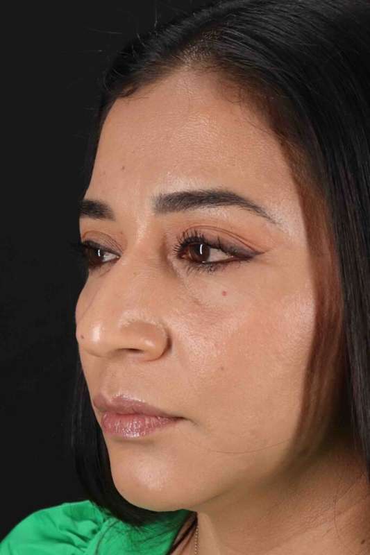 Rhinoplasty Before & After Patient #3082