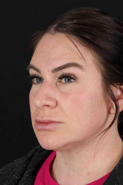 Rhinoplasty Before & After Patient #3093