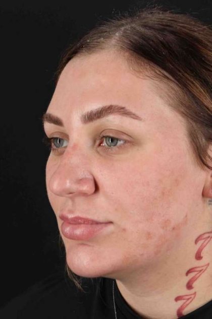 Rhinoplasty Before & After Patient #3104