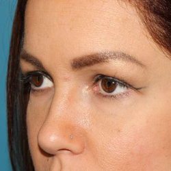 Browlift Before & After Patient #1384