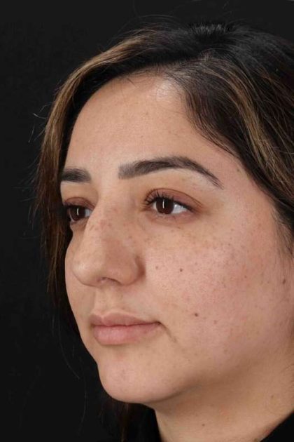 Rhinoplasty Before & After Patient #3115