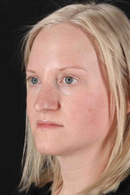 Rhinoplasty Before & After Patient #3126