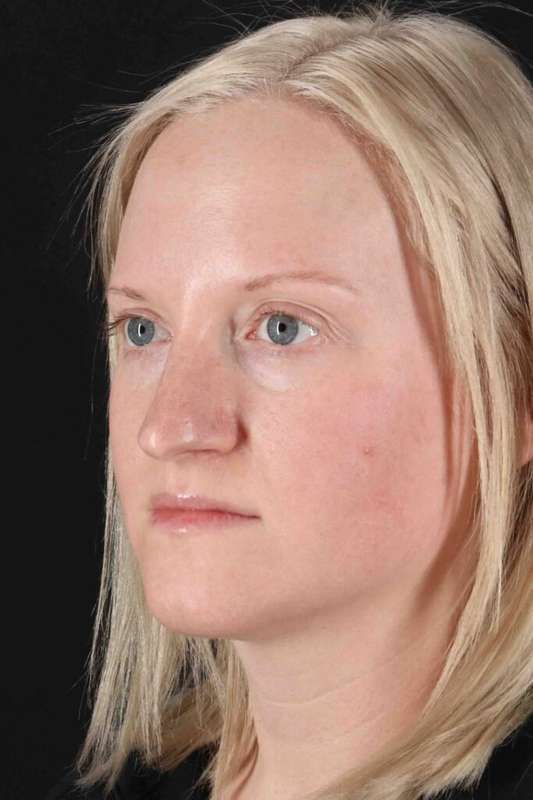 Rhinoplasty Before & After Patient #3126