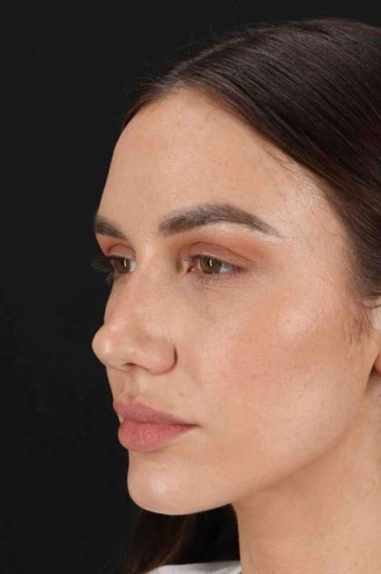 Rhinoplasty Before & After Patient #3137