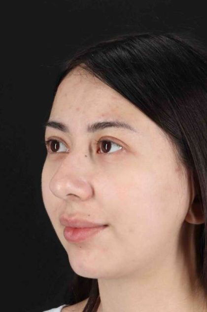 Rhinoplasty Before & After Patient #3159