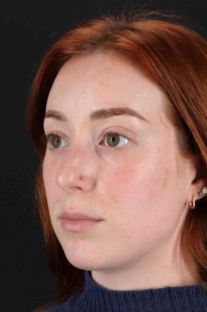 Rhinoplasty Before & After Patient #3170
