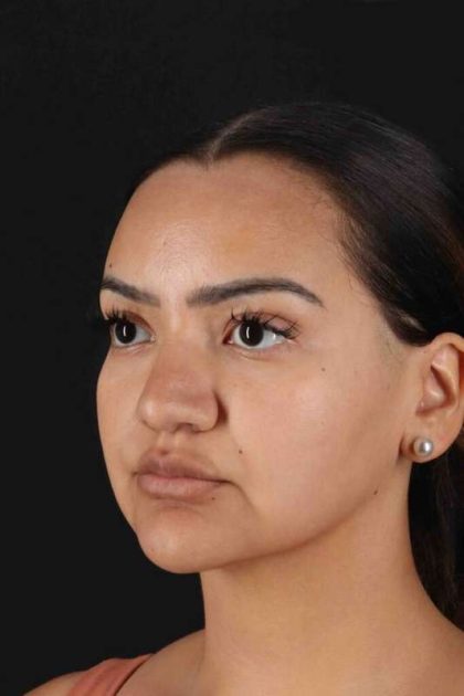 Rhinoplasty Before & After Patient #3192