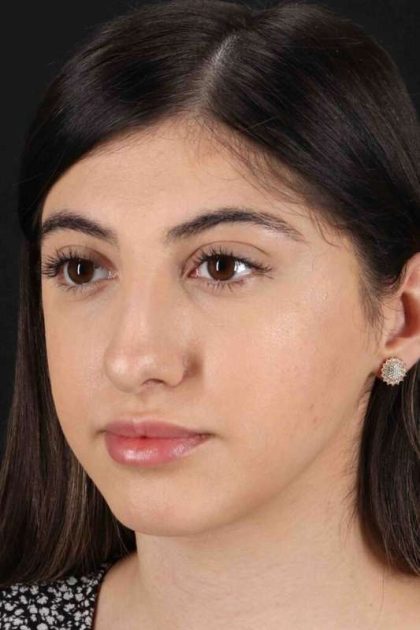 Rhinoplasty Before & After Patient #3214