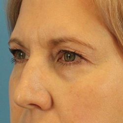 Browlift Before & After Patient #1402