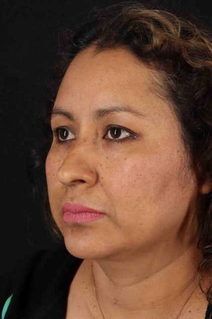 Rhinoplasty Before & After Patient #3225