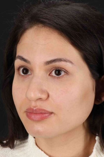 Rhinoplasty Before & After Patient #3236