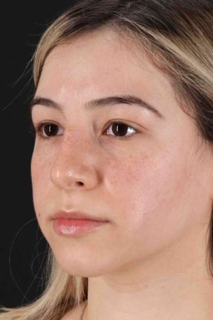 Rhinoplasty Before & After Patient #3247