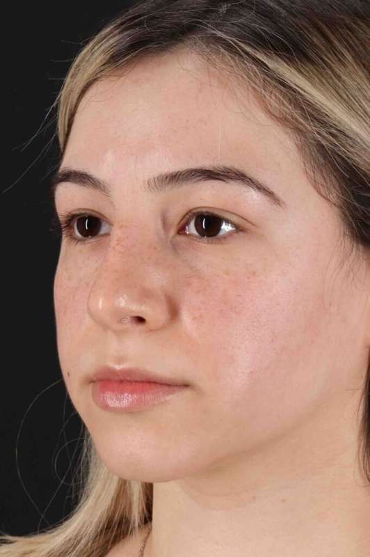 Rhinoplasty Before & After Patient #3247