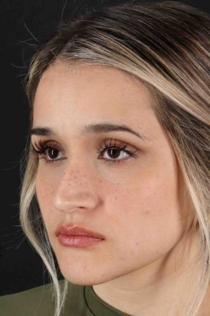 Rhinoplasty Before & After Patient #3258