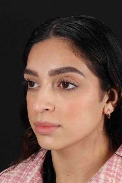 Rhinoplasty Before & After Patient #3269