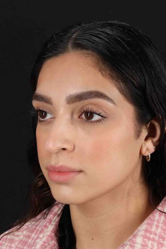 Rhinoplasty Before & After Patient #3269