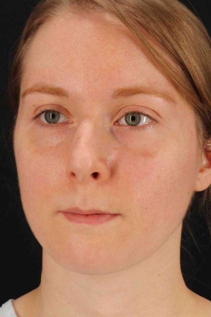 Rhinoplasty Before & After Patient #3280