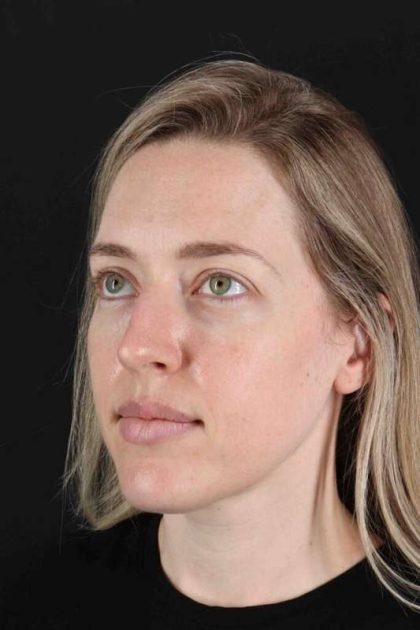 Rhinoplasty Before & After Patient #3291