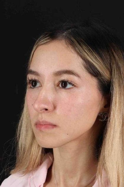 Rhinoplasty Before & After Patient #3302