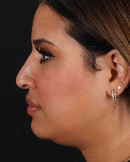 Rhinoplasty Before & After Patient #3324