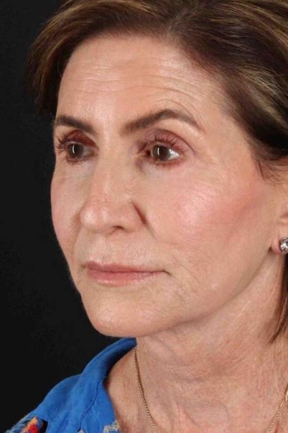 Co2 Laser Before & After Patient #3346