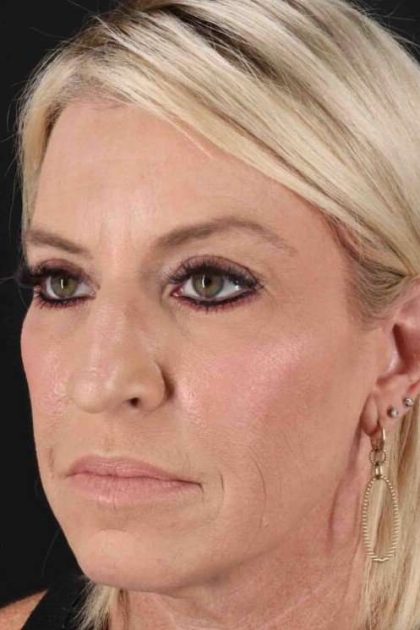 Upper Blepharoplasty Before & After Patient #3423