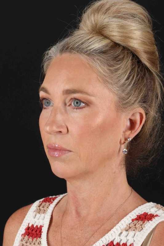 Upper Blepharoplasty Before & After Patient #3434