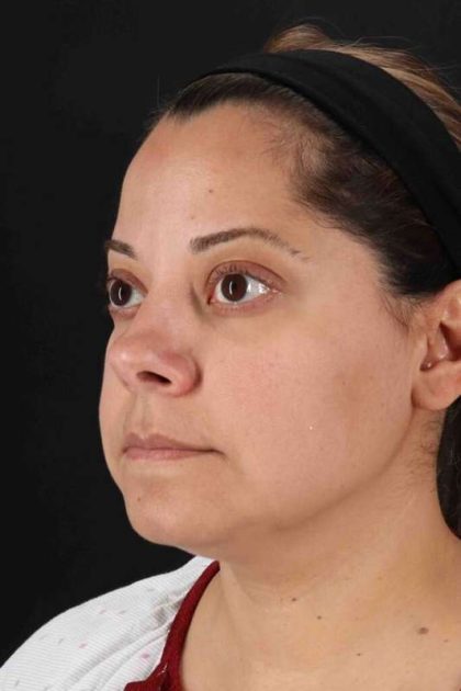 Buccal Fat Pad Before & After Patient #1436