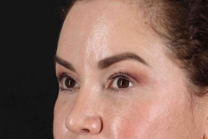 Upper Blepharoplasty Before & After Patient #3445