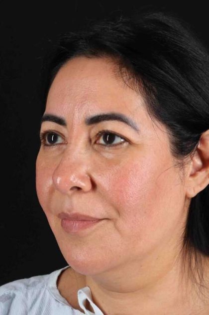 Upper Blepharoplasty Before & After Patient #3456