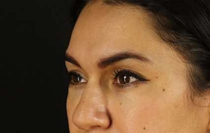 Upper Blepharoplasty Before & After Patient #3522