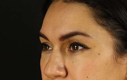 Upper Blepharoplasty Before & After Patient #3522