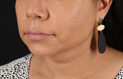 Facelift Before & After Patient #3555