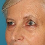 Lower Blepharoplasty Before & After Patient #2419