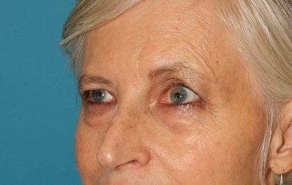 Upper Blepharoplasty Before & After Patient #3532
