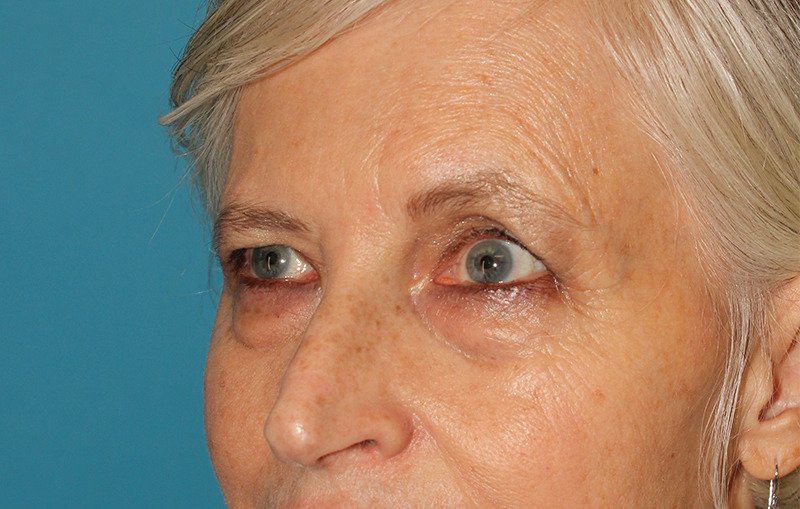 Upper Blepharoplasty Before & After Patient #3532