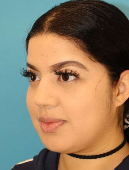 Buccal Fat Pad Before & After Patient #1485