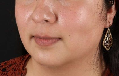 Chin Implant Before & After Patient #1529