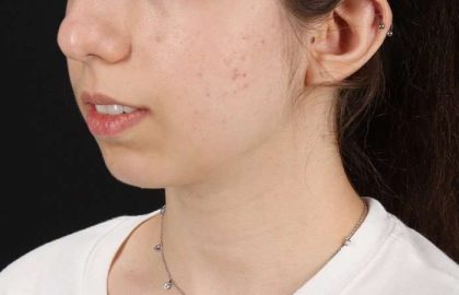 Chin Implant Before & After Patient #1551